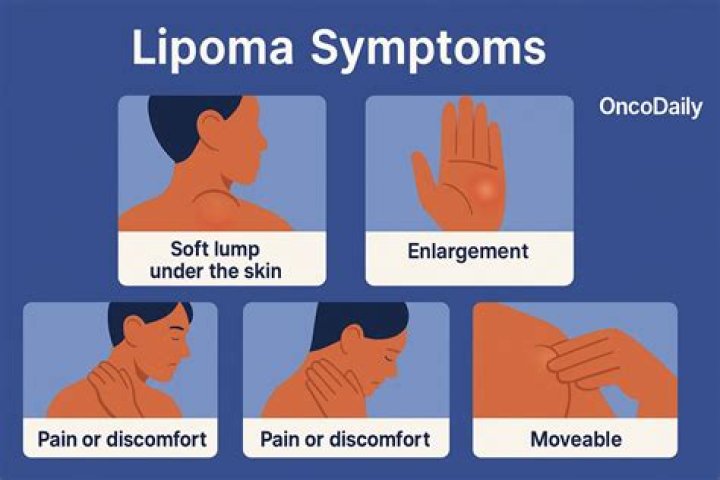 Can lipomas cause stomach problems?
