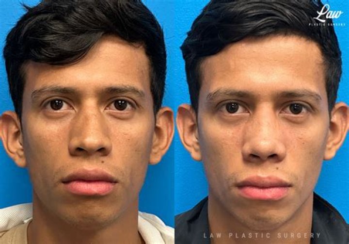 How long after septoplasty will I see results?