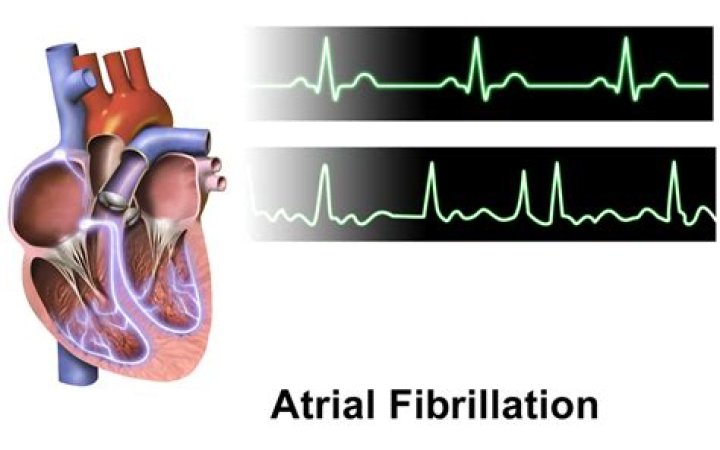 What can cause atrial fibrillation?