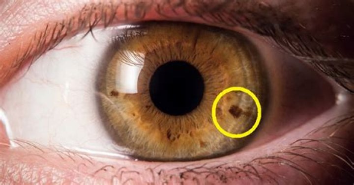 What does a brown spot on your eye mean?