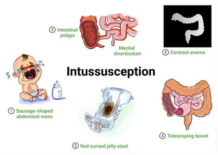 What does intussusception poop look like?