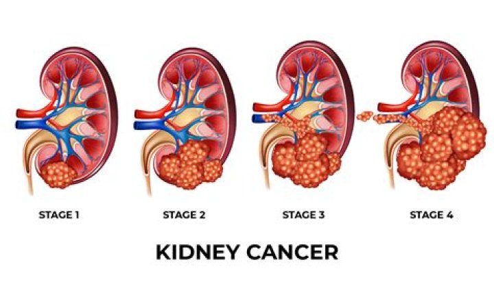 What pain do you get with kidney cancer?