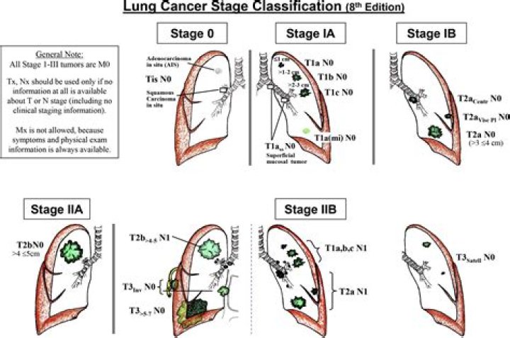 What stage is T2 lung cancer?